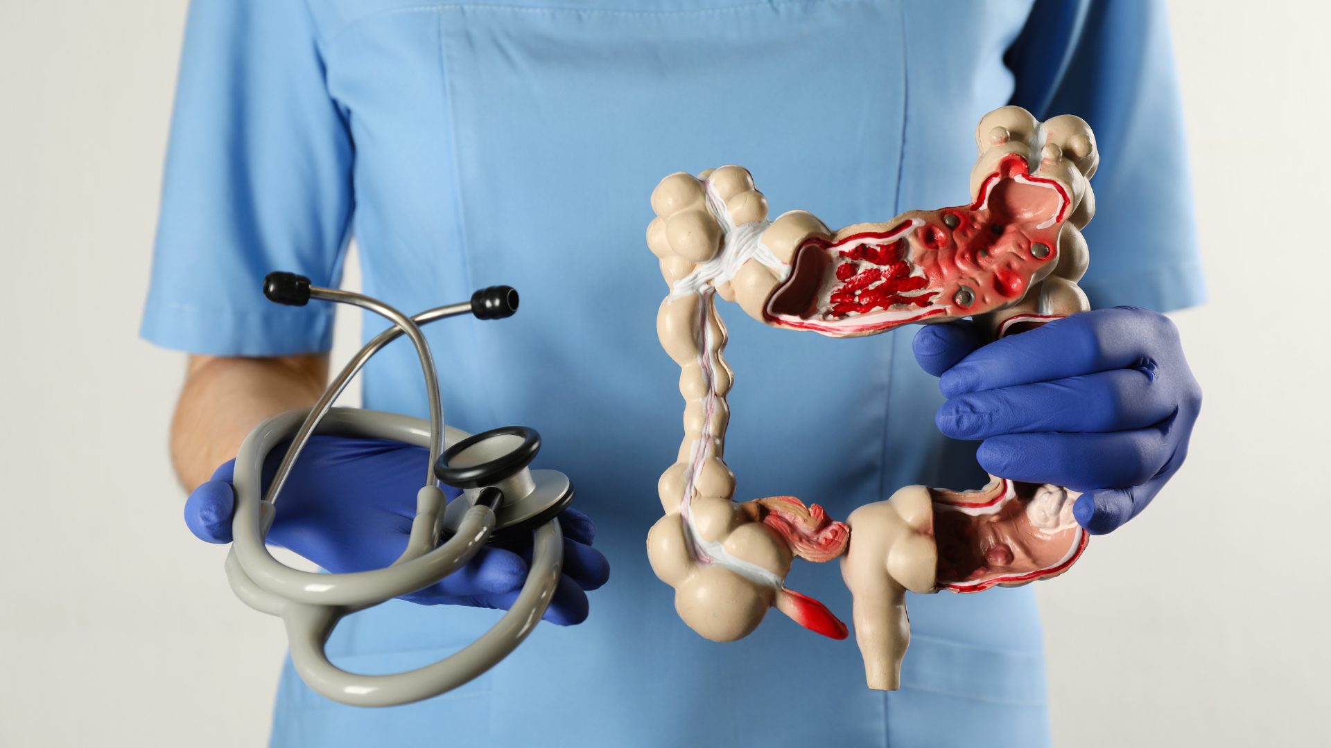 Colorectal cancer: Early detection can save your life 3