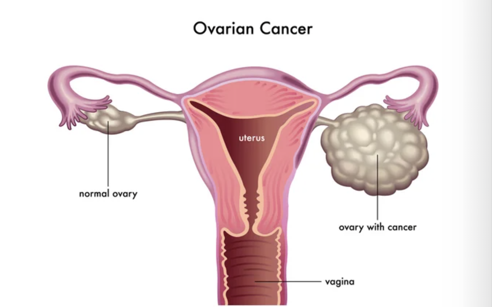 Cáncer de Ovario: Un desafío silencioso en la lucha contra los tumores ginecologicos