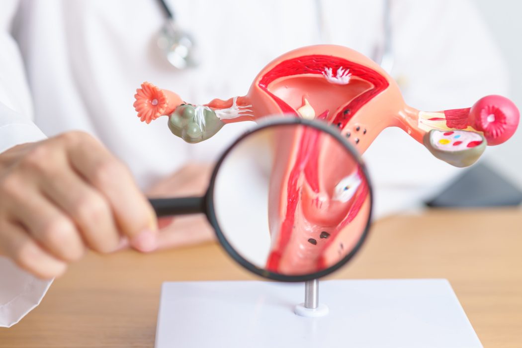 Histerectomía en panamá