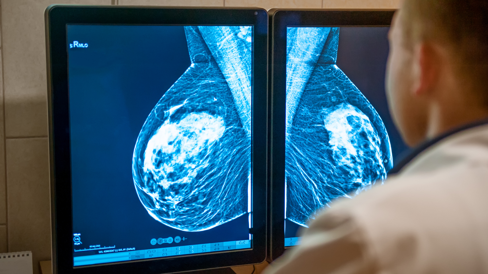 Evaluación médica de mamografía